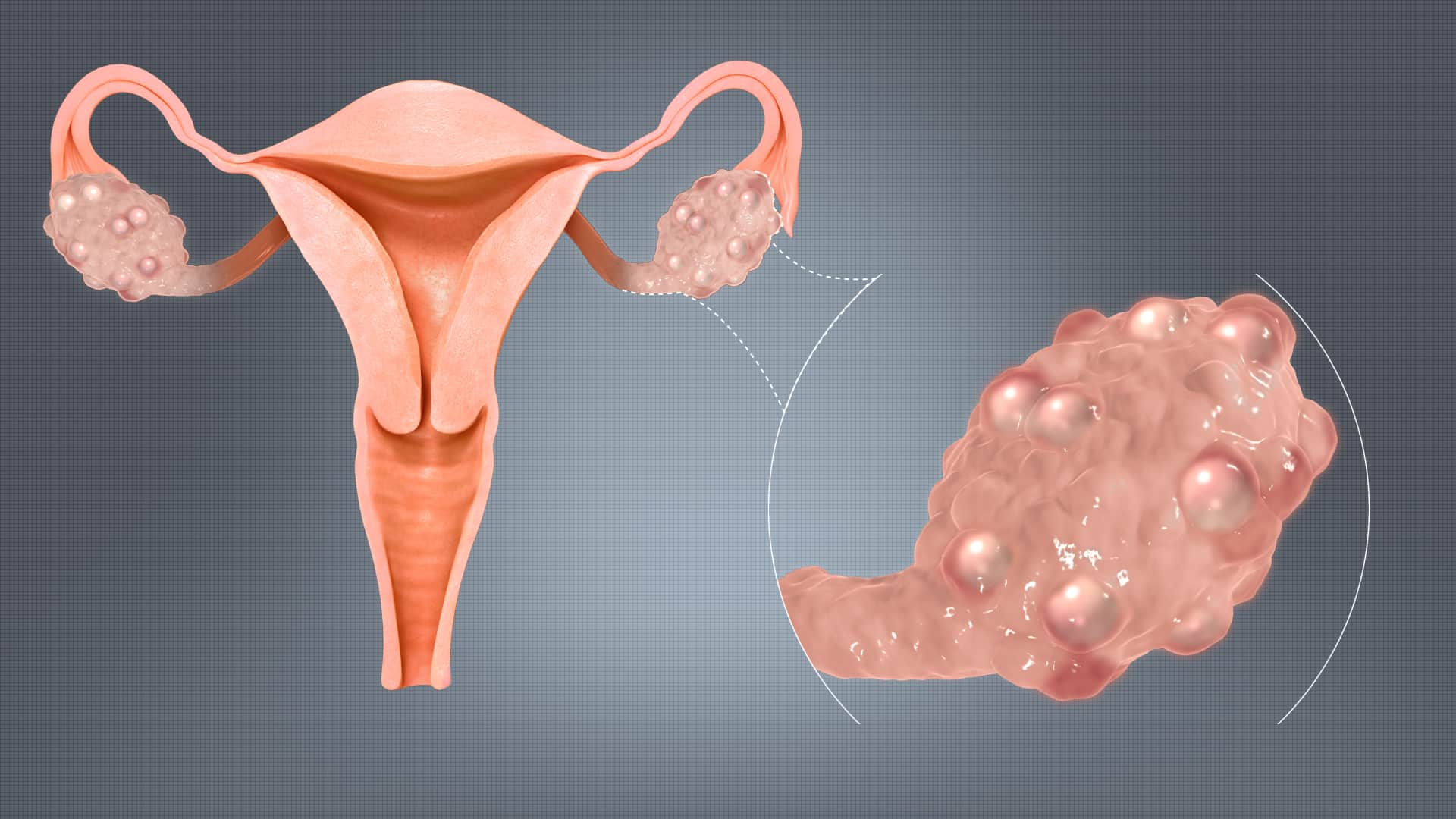PCOS Is Now PMOS: What the Name Change Means