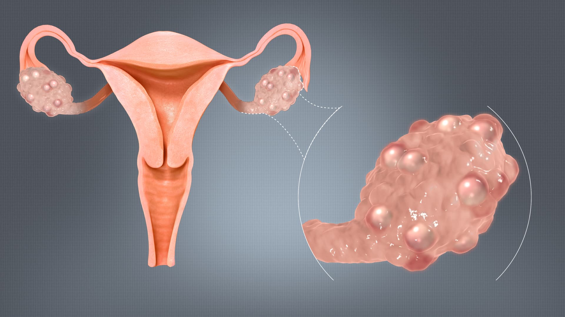 PCOS Is Now PMOS: What the Name Change Means