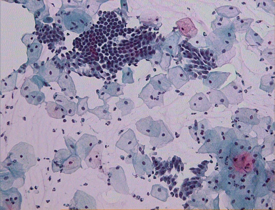 Is the “Cancer-Causing Chemical” on Your Pap Smear Brush Actually Dangerous?
