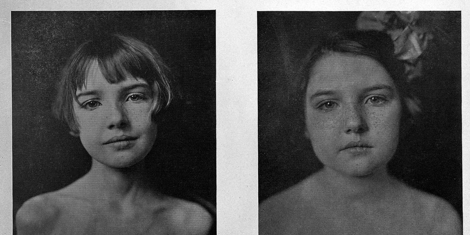 Insulin's 'Case VI': The Girl in the 1922 Before-and-After Photos