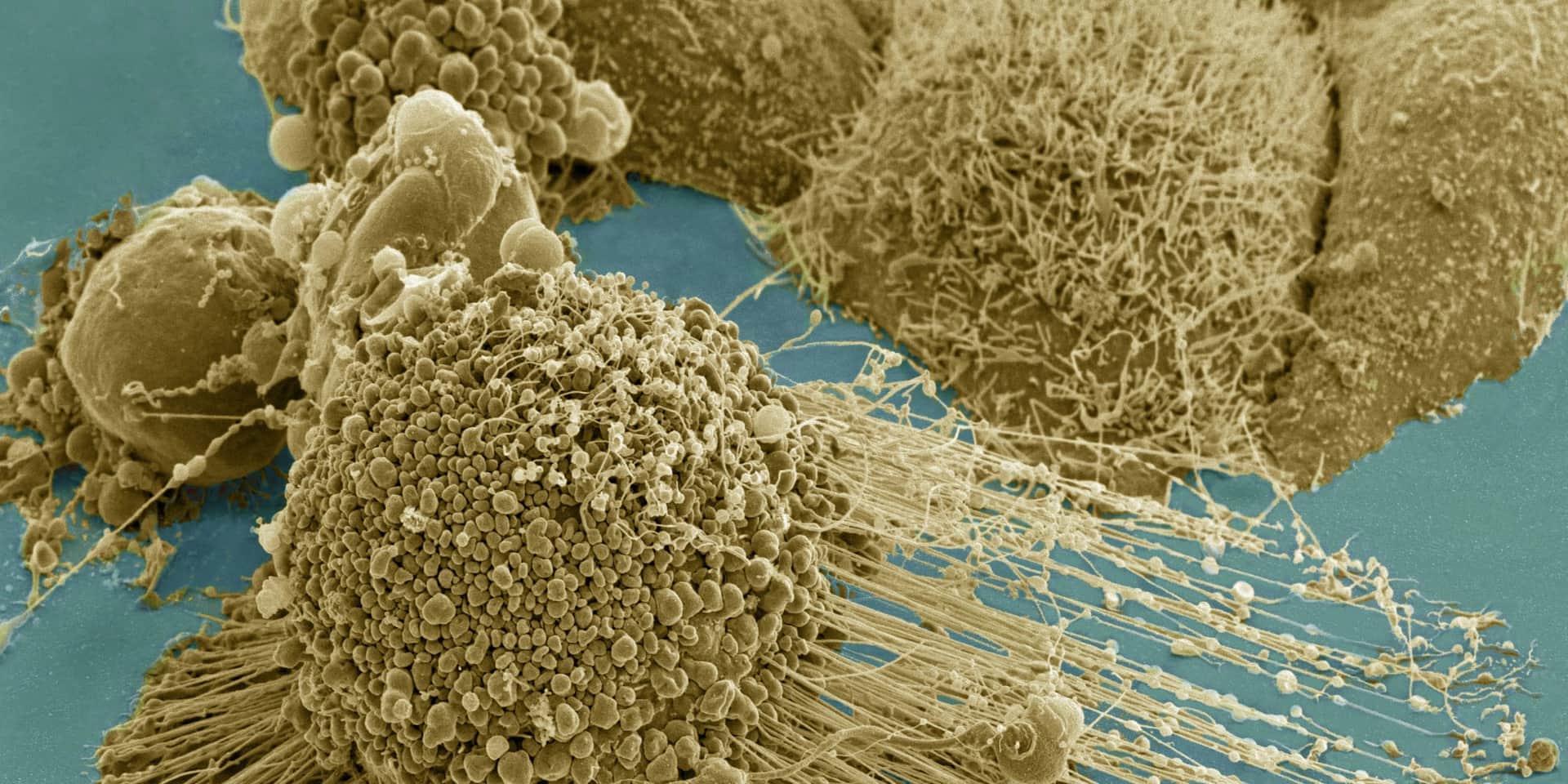 Japan's 'Self-Poisoning' Cancer Cells: What the Study Found