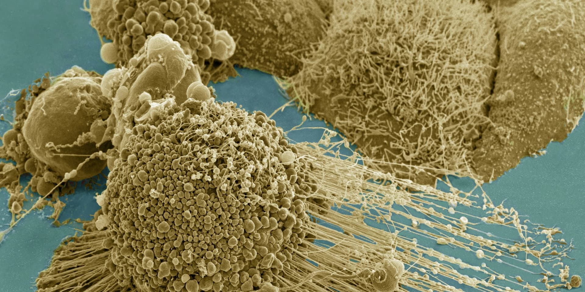 Japan's 'Self-Poisoning' Cancer Cells: What the Study Found