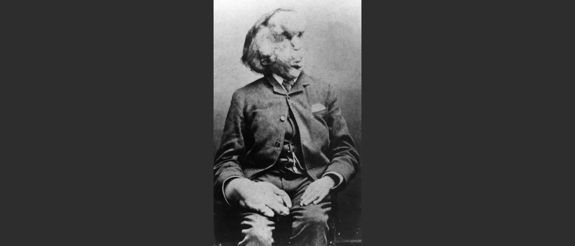 The 'Elephant Man' Skull Photo: Joseph Merrick's Real Story